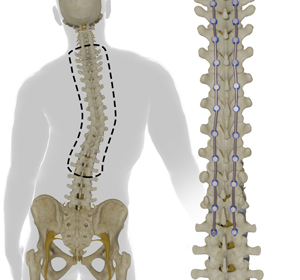 Adult Scoliosis Correction - Educational Picture