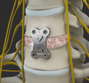 Anterior Cervical Discectomy with Fusion - Educational Picture