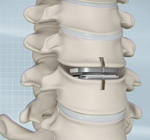 Artificial Cervical Disc Replacement - Educational Picture