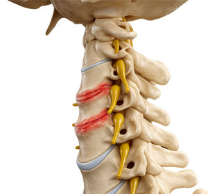 Cervical Degenerative Disorder - Educational Picture