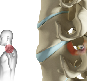 Cervical Foraminotomy - Educational Picture