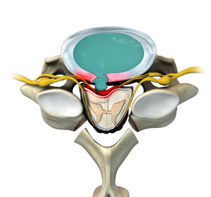 Cervical Laminectomy - Educational Picture