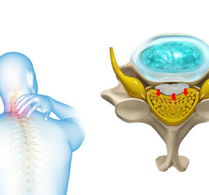 Cervical Myelopathy - Educational Picture