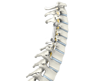 Cervical Spine Fusion - Educational Picture