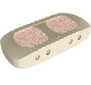 Direct Lateral Interbody Fusion - Educational Picture