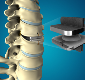 Disc Arthroplasty - Educational Picture