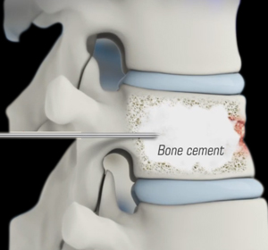 Kyphoplasty and Vertebroplasty - Educational Picture