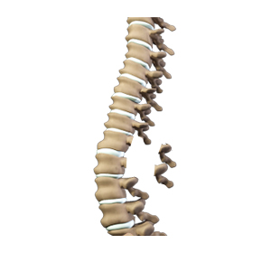 Laminectomy - Educational Picture