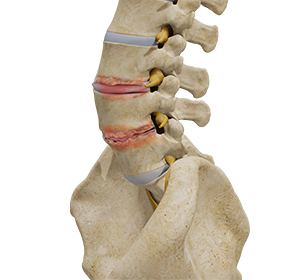 Lumbar Degenerative Disc Disease - Educational Picture