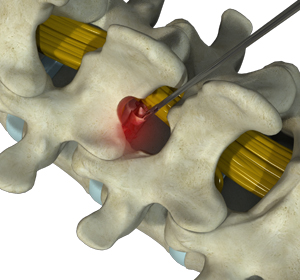 Microdiscectomy - Educational Picture