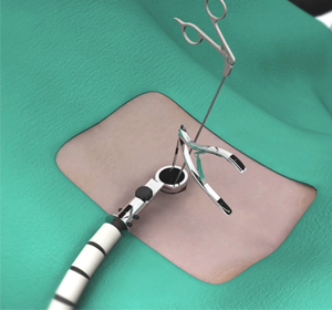 SpMinimally Invasive Spine Surgeryine - Educational Picture