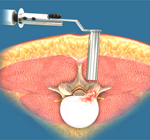 Minimally Invasive Spine Surgery - Educational Picture