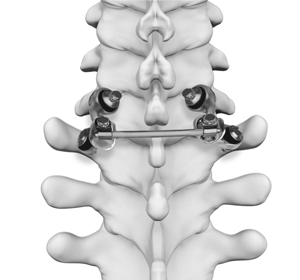 Motion Preservation Surgery - Educational Picture