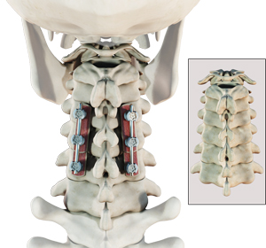 Posterior Cervical Fusion - Educational Picture