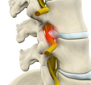 Radiculopathy - Educational Picture