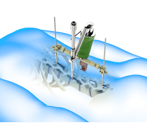 Robotic Spine Surgery - Educational Picture