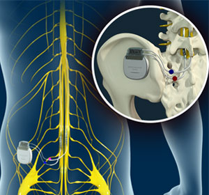 Spinal Cord Stimulators - Educational Picture
