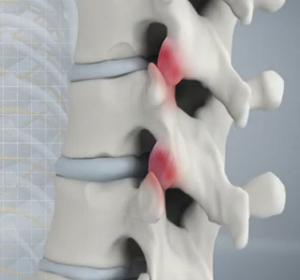 Spine Arthritis - Educational Picture