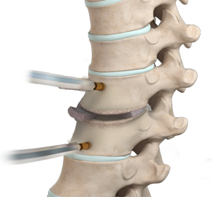 Thoracic Discectomy - Educational Picture