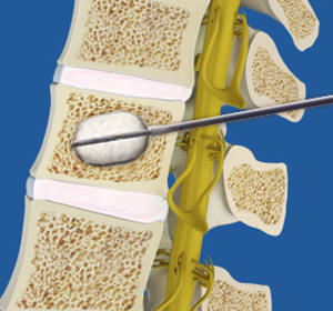 Thoracic Kyphoplasty - Educational Picture