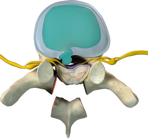Thoracic spine decompression - Educational Picture