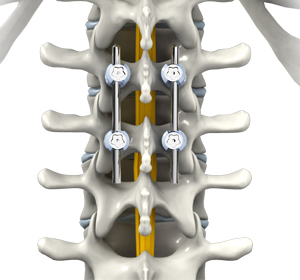 Thoracic Spine Fusion - Educational Picture
